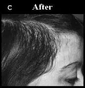 Close-up image of a woman's hairline, labeled "After," showing the results of a hair restoration treatment. The photo highlights the improved hair density and natural appearance post-treatment, emphasizing the effectiveness of the procedure. The woman's profile is visible, with focus on the scalp and hairline area, showcasing a positive transformation in hair growth. This image serves as a visual reference for individuals considering hair restoration options.