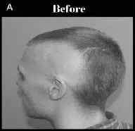Side profile of a man with a unique haircut showing significant hair loss on the top and sides, labeled "Before." The image highlights the uneven hair length and style, focusing on the contrast between the shaved areas and the remaining hair. This visual serves as a reference for hair transformation or styling options, emphasizing the distinct appearance of the hairstyle prior to any changes.