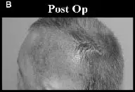 Post-operative image showing the scalp of a patient after hair restoration surgery. The focus is on the area where the procedure was performed, highlighting the healing process. The skin appears slightly red and raised, indicative of recent surgical intervention. This image serves as a visual reference for those considering hair restoration options, illustrating typical post-op conditions.