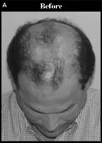 Top view of a man showing significant hair loss, with a receding hairline and thinning hair on the crown. The image highlights common patterns of male pattern baldness, often characterized by gradual hair thinning. This visual representation can be useful for discussions on hair restoration options, hair loss treatments, and the psychological impacts of baldness. The monochromatic scheme emphasizes the hair loss areas, aiding in understanding various stages of alopecia. This image serves as an educational resource for those exploring hair health and restoration solutions