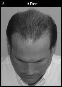 A man with thinning hair is shown from a top-down perspective, highlighting the sparse hair on the crown and front of his head. The image focuses on the hairline and scalp, illustrating common patterns of male hair loss. This visual representation can be useful for discussions on hair restoration options and treatments.