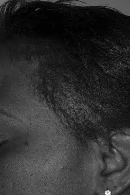 Close-up image of a person's scalp showcasing natural hair texture and patterns. The focus is on the hairline and the surrounding skin, highlighting the unique characteristics of textured hair. The monochrome color scheme emphasizes the details of the hair's curl pattern and growth direction. This image serves as a representation of diverse hair types, particularly in the context of natural hairstyles and hair care.