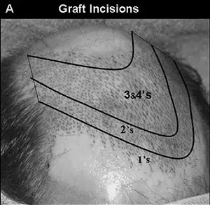 Illustration of graft incisions on a scalp, showing various incision lines labeled with measurements: 1 inch, 2 inches, 3 inches, and 4 inches. The diagram highlights the areas for hair transplant graft placements, providing a visual guide for medical professionals in hair restoration procedures. The image is in black and white, with clear demarcations to assist in understanding the grafting technique. This informative visual aids in educating patients and practitioners about the surgical process involved in hair transplantation.