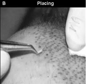 Close-up image showing a hand using tweezers to place hair follicles on a scalp during a hair restoration procedure. The background is blurred, focusing on the meticulous process of follicle placement. This technique is commonly used in hair transplant surgeries to enhance hair density and natural appearance. The image highlights the precision required in this cosmetic procedure, showcasing a skilled technique essential for successful outcomes in hair restoration.