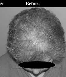 Close-up view of the top of a person's head showing thinning gray hair and a visible scalp. The image highlights hair loss patterns, commonly associated with aging or genetic factors. The background is neutral, ensuring the focus remains on the hair and scalp condition. Ideal for discussions on hair restoration, hair loss treatments, or aging-related hair issues.