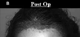 Post-operative image showing the scalp of a patient after hair restoration surgery. The photo highlights the hairline and surrounding area with visible signs of healing, including small scabs and hair follicles. This image is intended to illustrate the results and recovery process of hair transplant procedures. Ideal for individuals considering hair restoration options, it provides insight into the post-operative appearance and care needed during recovery.