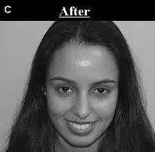Portrait of a young woman with long dark hair, smiling confidently. The image is labeled "After," indicating a transformation or result from a specific process. The background is neutral, ensuring the focus remains on her facial features and expression. This image may be used to illustrate the positive effects of a treatment or intervention in a before-and-after context.