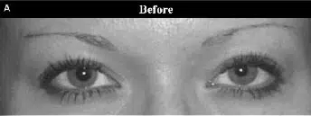 Close-up image of a person's eyes labeled "Before," showcasing their natural appearance prior to any cosmetic enhancements or treatments. The focus is on the eyes and eyebrows, highlighting their shape and features in a neutral lighting setting. This image serves as a visual reference for cosmetic procedures or beauty transformations.