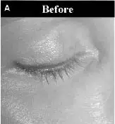 Close-up image of a closed eyelid, labeled "Before," showcasing the natural texture and appearance of the skin around the eye. The image highlights the eyelash length and the subtle details of the eyelid's surface. This visual serves as a comparative reference for cosmetic treatments or skincare results. Ideal for educational or promotional content in the beauty and skincare industry.