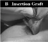 Image depicting a surgical procedure for a B insertion graft, showcasing a close-up of a hand holding surgical instruments while performing the grafting technique. The image highlights the precision involved in the procedure, emphasizing the importance of careful manipulation of tissues during the insertion. This visual aids in understanding the grafting process used in medical practices, particularly in reconstructive surgery.