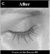 Close-up image of an eye with eyelashes after a cosmetic procedure, showcasing enhanced lash length and volume. The eyelid is gently closed, revealing well-defined, healthy lashes. The image is labeled "After," indicating the results post-treatment. This visual demonstrates the effectiveness of eyelash enhancement techniques, appealing to individuals interested in beauty and cosmetic improvements.