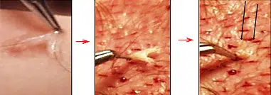 Close-up image of a skin surface showing a hair follicle being extracted with a tweezer. The background features fine hair and skin texture, with visible pores and minor blemishes. This detailed view illustrates the hair removal process, commonly seen in dermatological treatments. The image highlights the precision required in extracting hair follicles for various skin procedures.