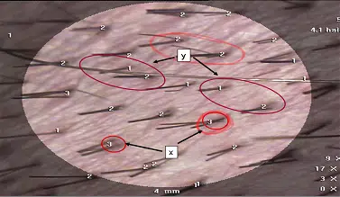 Microscopic view of hair strands showing detailed features. The image highlights various hair structures, with labeled annotations indicating specific characteristics. Red circles emphasize areas of interest, such as hair texture and growth patterns. The scale bar at the bottom indicates a measurement of 4 mm, providing context for the size of the hair strands. This visual aids in understanding hair morphology, useful for studies in dermatology and trichology.