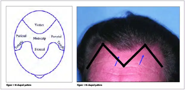 Illustration showing two images: on the left, a diagram labeled "Parietal" with a circular shape and wavy lines indicating brain wave patterns; on the right, a close-up of a person's forehead displaying a zigzag pattern marked in black. The image highlights the relationship between brain activity and physical manifestations, useful for studies in neurology or psychology. This visual aids in understanding the correlation between brain patterns and external indicators.