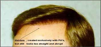 Image of a hairline showing a straight and abrupt appearance, indicating that the hair restoration was done exclusively with follicular units (FUs). The image highlights the unnatural look of the hairline, suggesting a need for a more natural design in hair transplant procedures. This visual serves as a reference for individuals considering hair restoration options, emphasizing the importance of hairline aesthetics in achieving a natural look.