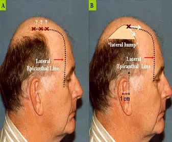 Image comparing two side profiles of a man showing hairline variations. The left profile illustrates a receding hairline with marked points indicating the lateral and superior epicranial lines. The right profile depicts a more defined hairline with a lateral bump highlighted. This visual aids in understanding hairline anatomy and changes related to hair loss, useful for educational purposes in dermatology or hair restoration discussions.