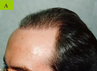 Close-up image of a person's scalp showing thinning hair at the front, indicating early signs of male pattern baldness. The hair is dark and styled back, with noticeable receding hairline. The background is neutral, focusing attention on the hair condition. This image illustrates common hair loss issues, relevant for discussions on hair restoration treatments and solutions.