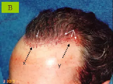 Image of a male patient’s forehead post-hair transplant procedure, showcasing marked areas (labeled X and Y) indicating hairline restoration. The scalp appears slightly red, highlighting the surgical sites where hair follicles were transplanted. The image serves as a visual reference for the hair restoration process, illustrating the precision involved in creating a natural-looking hairline. This educational image is beneficial for individuals considering hair transplant options, providing insight into the procedure's appearance and recovery.