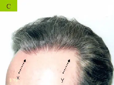Close-up image of a person's scalp showing the hairline with arrows labeled "X" and "Y" indicating specific points on the forehead. The hair is predominantly gray, and the focus is on the hair growth pattern and hairline shape. This image is relevant for discussions on hair restoration, hairline design, and scalp health, providing a visual reference for professionals in the hair industry.