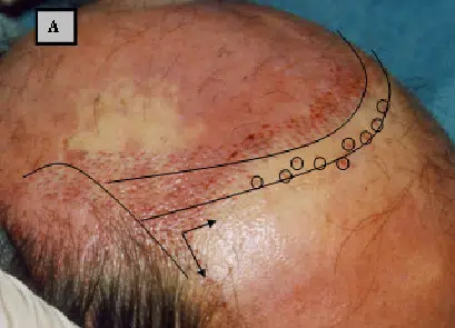 Image of a scalp with a marked hairline for hair restoration surgery. The scalp shows redness and outlines indicating the planned area for hair follicle extraction. Dots are placed along the contour to guide the procedure. This image is relevant for discussions on hair transplant techniques and scalp health.