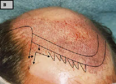 Image of a scalp with marked lines indicating a hair transplant procedure. The drawing outlines the desired hairline and graft placement for optimal results. The skin appears slightly red, suggesting preparation for surgery. This image is relevant to discussions on hair restoration techniques and the planning stages of hair transplant surgery.
