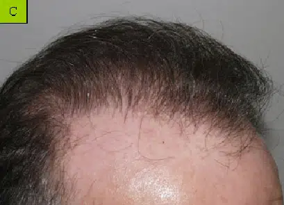 Close-up view of a person's hairline, showing fine, dark hair with a receding pattern. The scalp is visible, highlighting the contrast between the hair and skin tone. This image emphasizes the natural texture of hair and may relate to discussions about hair loss or grooming. Ideal for content focused on hair care, hair restoration options, or men's grooming.
