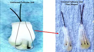 Image comparing a follicular unit and a trimmed follicular unit, highlighting the differences in structure. On the left, the intact follicular unit is shown with a dotted outline, while the right side displays the trimmed "pear-shaped" follicular unit. The image serves as a visual aid for understanding hair follicle anatomy, commonly used in hair restoration procedures.