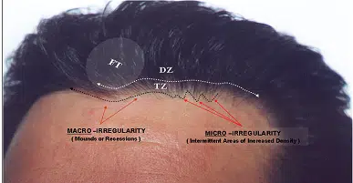 Image illustrating hairline characteristics, featuring labeled areas indicating "FT" (frontal temporal), "DZ" (donor zone), and "TZ" (transitional zone). The diagram highlights two types of irregularities: macro-irregularity, relating to lumps or recessions, and micro-irregularity, indicating areas of thinning. The image serves as an educational resource for understanding hairline patterns and potential hair loss conditions.