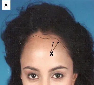 Image of a woman with dark hair and a neutral expression, displaying a marked forehead. The image includes lines and an 'X' indicating specific points on the forehead, likely for medical or cosmetic analysis. The background is a solid blue color, providing contrast to the subject. This image may be used in discussions related to cosmetic procedures, dermatology, or facial anatomy.