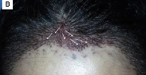 Close-up image of a scalp showing multiple hair follicles with tiny needles inserted, indicating a hair restoration treatment. The area is marked with some redness, typical after procedures like scalp micropigmentation or hair transplant. The image highlights the intricate process involved in enhancing hair density and appearance.