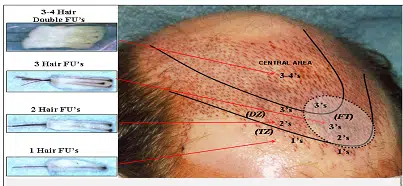 Image showing a close-up view of a scalp with marked lines indicating areas for hair restoration. The central line is labeled "CENTRAL" with measurements of 3-4 cm. Other lines are labeled (T1) and (T2) with corresponding measurements of 2 cm and 3 cm, respectively. This image is useful for understanding hair transplant procedures and scalp anatomy in relation to hairline design. It highlights the importance of precise measurements for effective hair restoration outcomes.