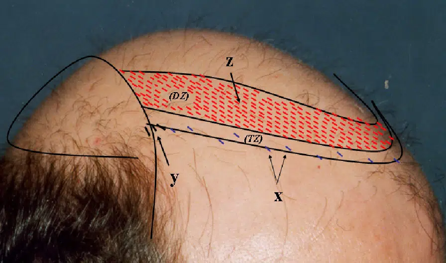 Diagram illustrating a section of a bald scalp with labeled areas indicating mathematical variables and measurements. The image emphasizes the geometry of the scalp's curvature, with red shading to denote specific regions. Labels include x, y, z, and other variables, providing a clear visual reference for understanding anatomical or mathematical concepts related to scalp topology. This educational image is useful for studies in dermatology, trichology, or geometry.