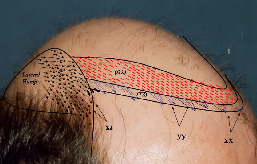 Illustration of a scalp showing a detailed diagram of hair follicles and their growth patterns. The image features labeled sections with red and blue markings, highlighting different areas related to hair density and distribution. This educational graphic aims to provide insight into the anatomy of the scalp, particularly for discussions on hair loss and restoration techniques. Ideal for dermatology and trichology contexts, the image serves as a visual aid in understanding hair biology and related medical treatments.