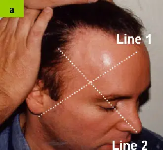 Image showing a close-up of a man's head, with two dotted lines labeled "Line 1" and "Line 2" indicating reference points for a hairline assessment. The man has dark hair pulled back, and the image focuses on the forehead and hairline area. This visual aids in understanding hairline evaluation techniques, commonly used in hair restoration consultations. The image provides a clear view of the angles and reference lines for accurate measurements.