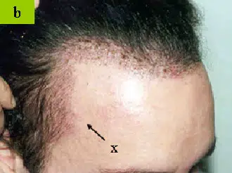 Close-up image of a person's forehead showing signs of hair thinning or recession. An arrow points to a specific area of concern on the scalp, highlighting hair loss patterns. The image is useful for discussions on hair restoration treatments and scalp health. It serves as a visual reference for individuals considering options for hair regrowth or seeking advice on managing hair loss.