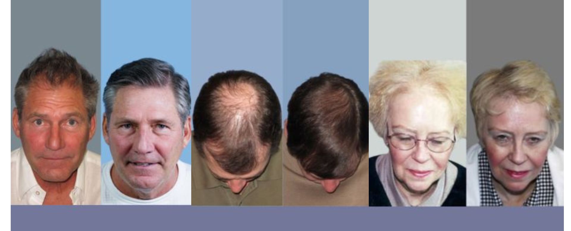 The-Best-Treatment-for-Hair-Loss-2