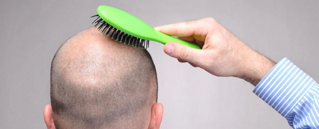 A close-up image of a hand using a green hairbrush on a bald head. The focus is on the brushing action, highlighting hair care and grooming practices. The background is neutral, emphasizing the subject of hair maintenance. This image illustrates personal grooming routines, suitable for discussions on hair care products and techniques.