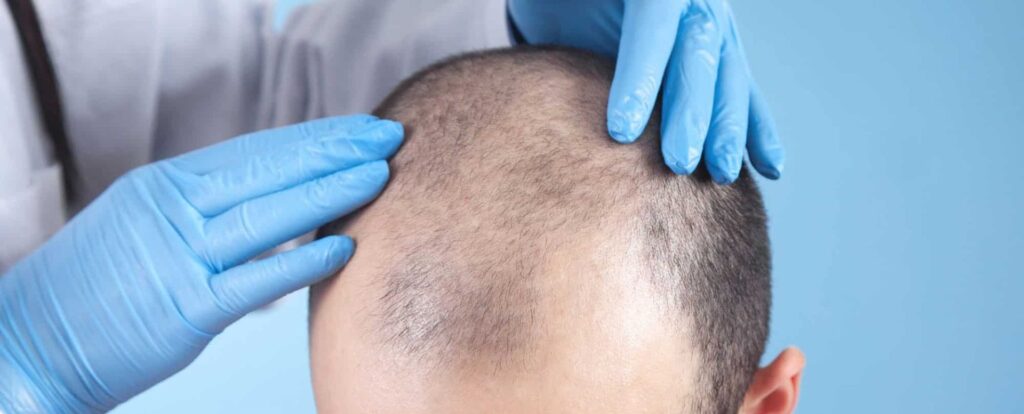 Medical professional examining a bald scalp with gloved hands, focusing on hair loss treatment options. The image highlights the importance of addressing hair thinning and baldness, often experienced by men and women. This visual representation is relevant for discussions on hair restoration procedures and dermatological consultations.