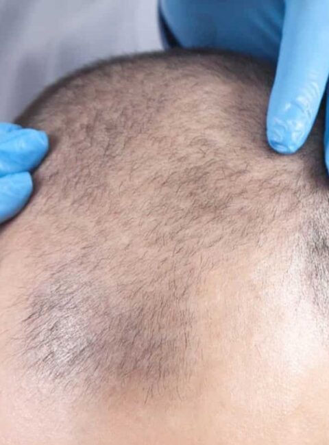 The-Ultimate-Guide-to-Medical-Therapy-for-Hair-Loss-4