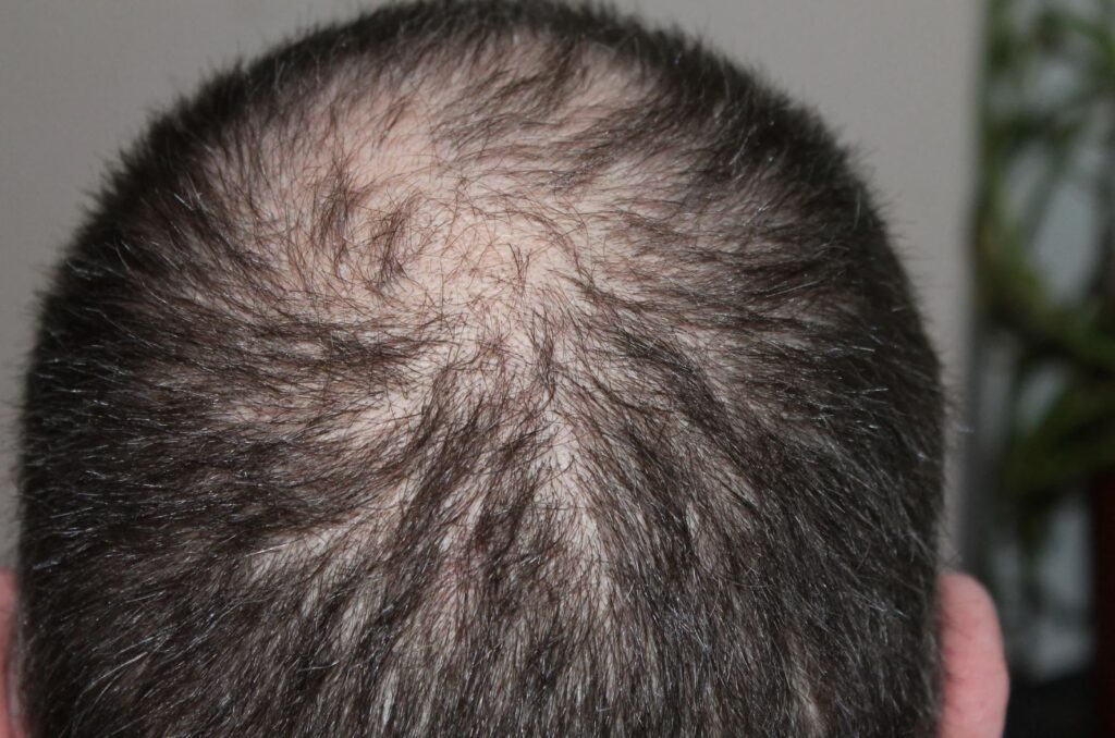 Close-up view of the top of a human head showing thinning hair and a bald spot. The image highlights the texture and color of the remaining hair, providing a clear visual of hair loss patterns. This representation is relevant for discussions on hair health, alopecia, and hair restoration treatments.