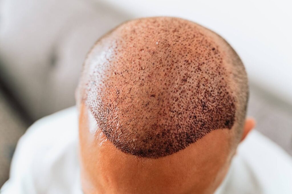 Close-up view of a scalp undergoing hair restoration treatment, showcasing a freshly treated area with tiny dots indicating follicle placement. The skin appears slightly shiny and has a natural tone, highlighting the precision of the procedure. This image is relevant for discussions on hair transplant techniques and post-operative care, offering insights into the appearance of the scalp immediately after treatment. Ideal for educational content about hair restoration options for individuals experiencing hair loss.