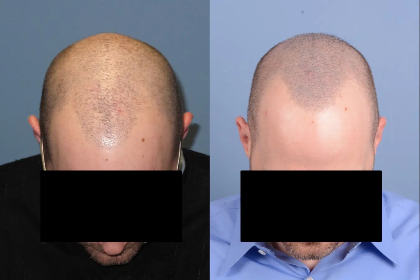 Before and after images of a male patient showcasing hair restoration results. The left side displays significant hair thinning and baldness, while the right side shows improved hair density and coverage after treatment. Both images emphasize the patient's scalp from a top-down view, highlighting the transformation achieved through hair restoration techniques. This visual comparison serves to inform potential patients about the effectiveness of hair transplant procedures.