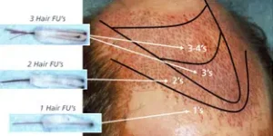 Incisions made in pattern that mimics nature